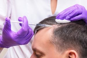 היתרונות של ניתוח השתלות שיער לגברים ונשים